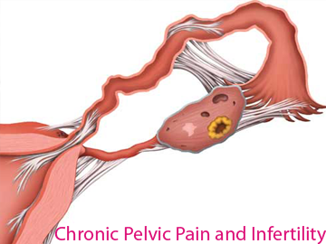 Chronic Pelvic Pain and Infertility