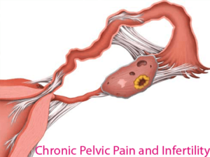 Chronic-Pelvic-Pain-and-Infertility