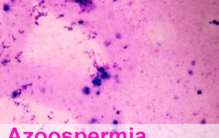 Azoospermia- What are my options