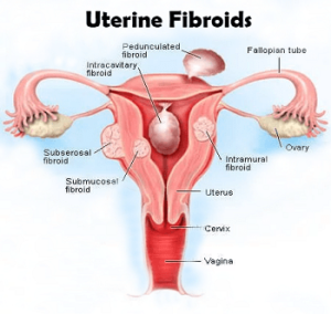 uterine-fibroid