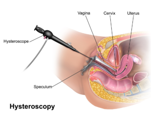 about-hysteroscopy-surgery