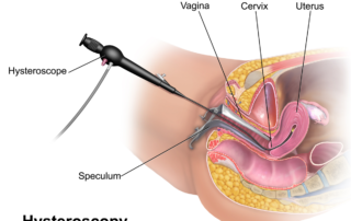 about-hysteroscopy-surgery
