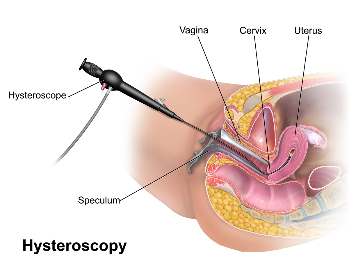 hysteroscopy-surgery
