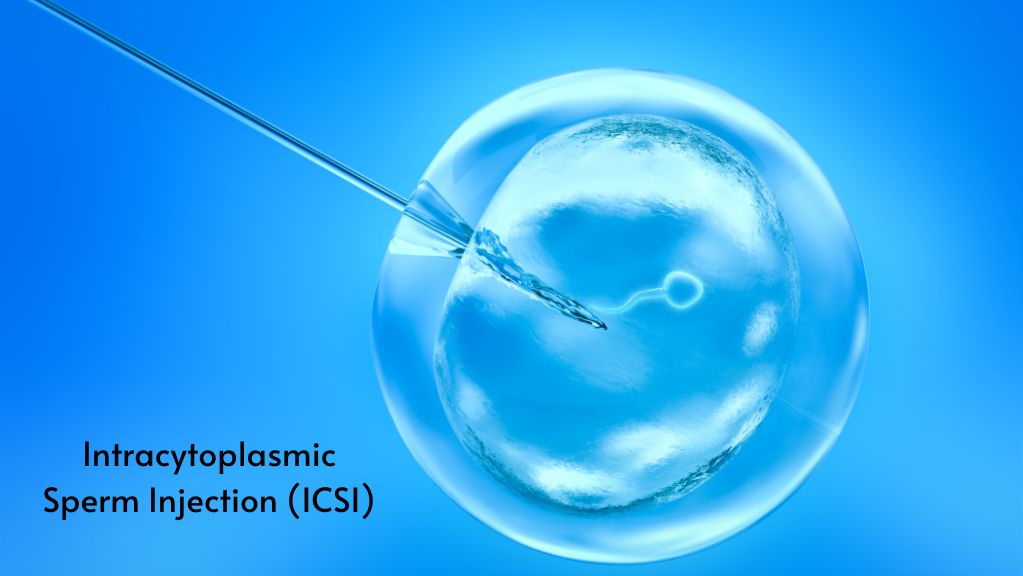 Intracytoplasmic Sperm Injection (ICSI